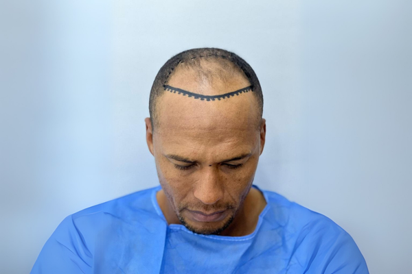 Trasplante Capilar Afro para Hombres