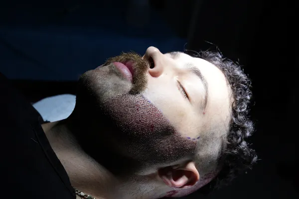 Trasplante de Barba
