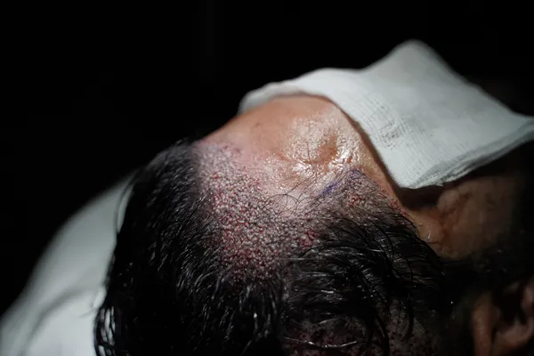 Trasplante en Áreas Quemadas/Heridas